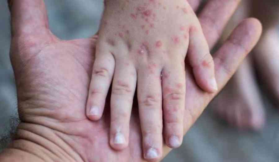 Un niño de 10 años es el caso sospechoso de sarampión en Villa Montes