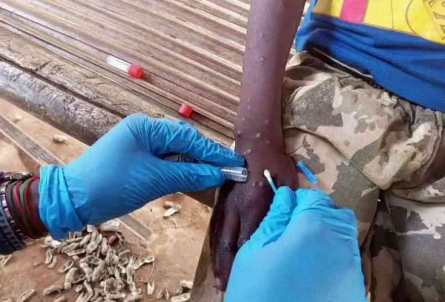 Sedes La Paz anuncia vigilancia activa de la viruela símica en aeropuertos