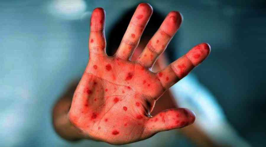 La cifra de casos de sarampión sube a 40 positivos, 39 en Santa Cruz